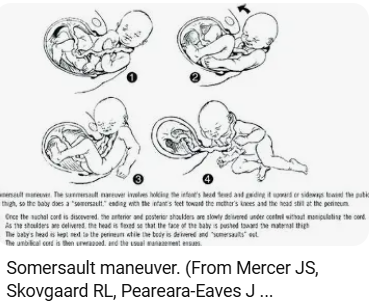 Somersault manoeuvre for a tight nuchal cord at birth